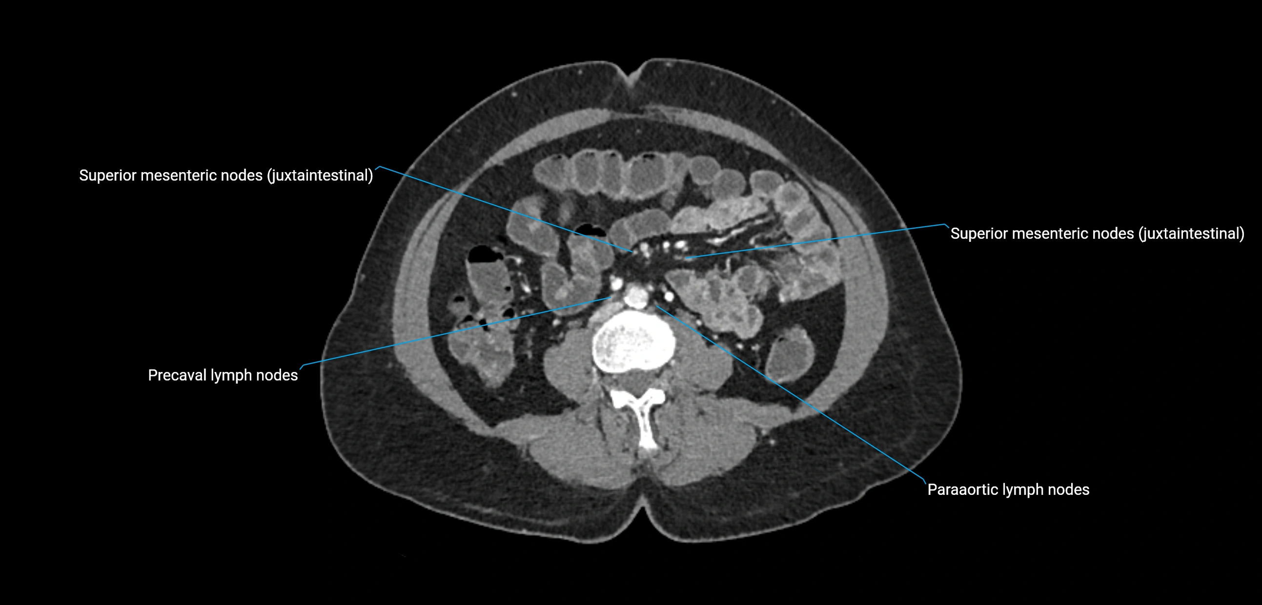 CT ct abdominal lymph nodes  axial cross sectional anatomy  enchanced radiology image -img-00002-00247.webp